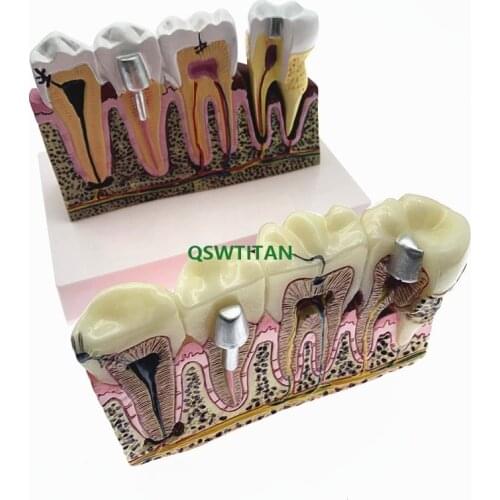 Dental Caries Comparation Anatomy Teeth Model for Dental Anatomy Lab Teaching Studying Model