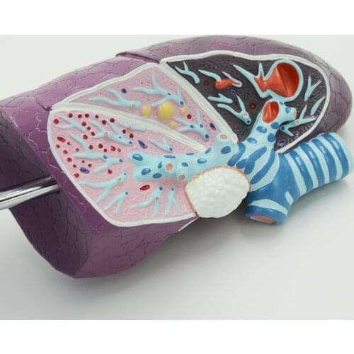 Diseased Human Lung Structure Respiratory System Model for Anatomical Study Display Teach Anatomy Medical Supply and Equipment