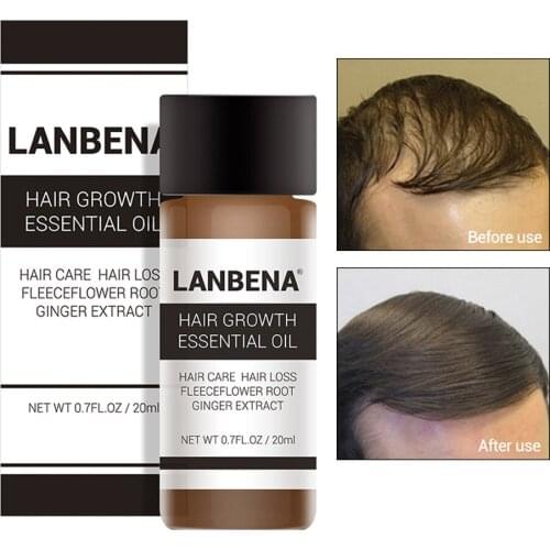 Fast Hair Growth Ginger Essential Oil TCM Effective Extract Anti Hair Loss Treatment Regrowth Nourish Hair Care For Men women