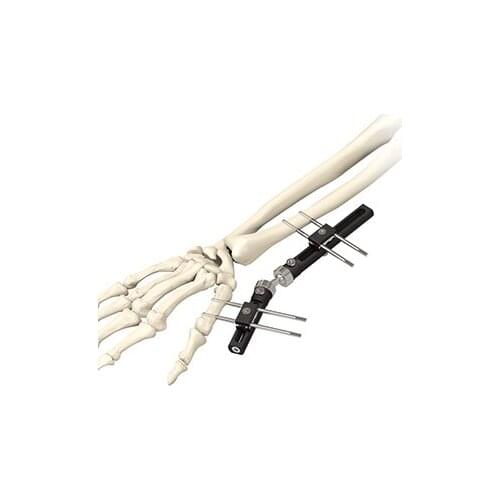 Orthopedic PEEK Radiolucent external fixation for wrist