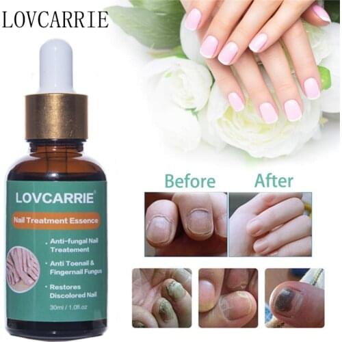 NEW 30ML Nail Treatment Fungus Essence Nail Repair Cuticle Oil Remover Fungal Gel Anti Infection for Nails Toenail Care Restore