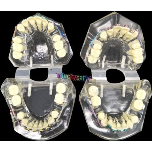 1pcs Dental Tooth Orthodontic Model With Colorful Brackets Malocclusion Models Teaching Model Dentistry Material Dentist Tools
