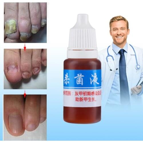 10ml Nail Fungus Treatment Cream Onychomycosis Paronychia Anti Fungal Nail Infection Kills Bacteria and Fungus