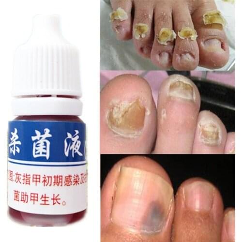 Anti Infection Fungal Nail Treatment Liquid Foot Care Essence Whitening Toe Nail Fungus Removal Gel Paronychia Onychomycosis