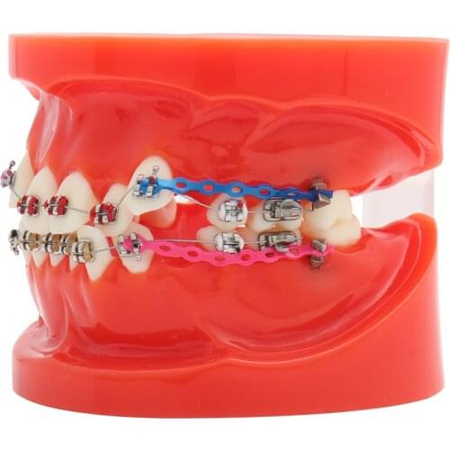 Dental Standard Orthodontic Teeth Model with Brackets & Buccal Tubes & Ligature Wire Orthodontic Treatment Red