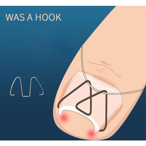 2box Stainless Steel Toe Nail Correction Toenail Straightening Clip Armor Corrector Patch Tool Set Ingrown Toe Nail Fixer