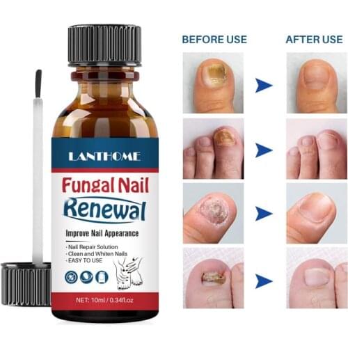Fungal Nail Repair Serum Toe Onychomycosis Nails Care Nail Discolorations Hand And Foot Nail Repair Liquid Skin Care TSLM1