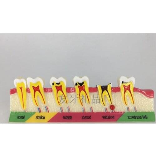 Dental caries classification model dental teaching demonstration oral model