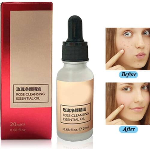 20ML Rose Essential Oil Skin Tag Removal Remove Moles And Repair Scars Painless Dark Spot Clean Face Wart Freckle Removal Cream