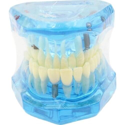 1pcs Dental Model teeth implant Restoration Bridge Teaching Study Tooth Medical Science Disease Study Dentist Dentistry products