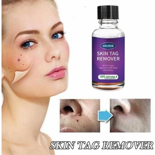 No Trace Wart Liquid Genital Warts Foot Calluses Removal Medical Feet Meat Corn Tag Relief Treatment Cream 10/20/30ml Skin Care