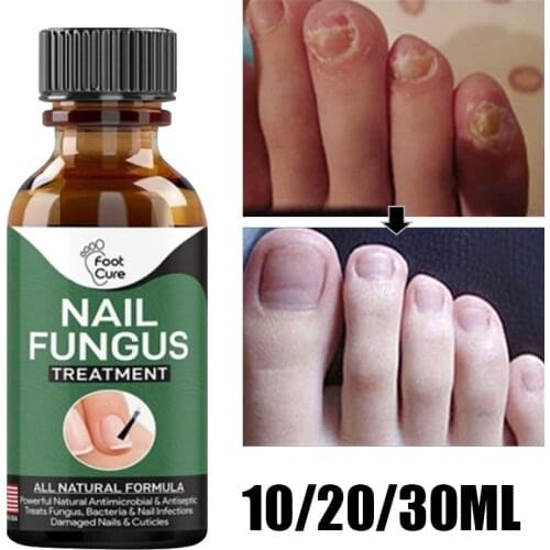 1pcs Nail Fungal Treatments Repairing Essences Serum Care Toe Foot Nail Fungus Removal Gel Paronychia Onychomycosis Liquid Serum