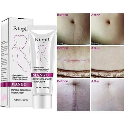10PCS/Lot Mango Remove Stretch Mark Cream Anti-stretching Cream Remove Pregnancy Scars Acne Cream Natural Mild Non-irritating