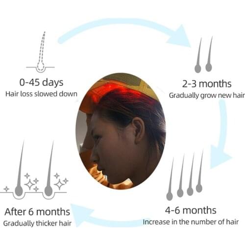 Laser hair loss solution cap helmet low level laser therapy for hair growth