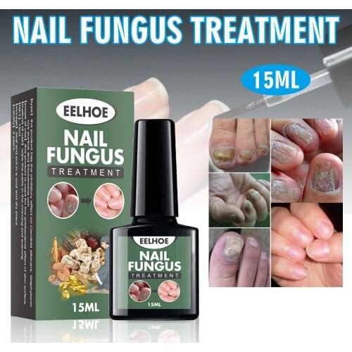 15ml Nail Fungus Treatment Care Nail Repair Stop Fungal Growth Fingernail Toenail Essences Serum Nails Care Treatments