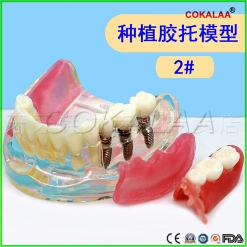 Good quality Planting Resin Coverager model dental implant model dentures teeth model for dentists learning