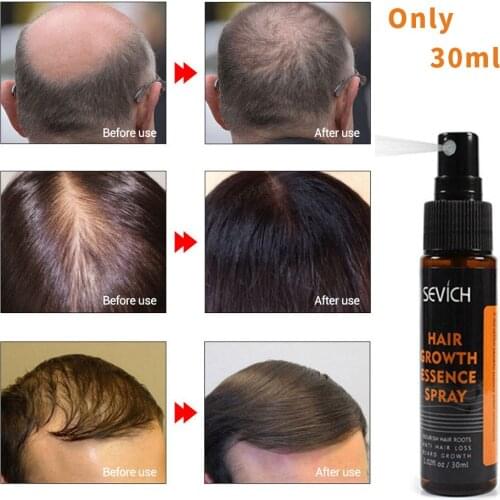 30ml Hair Growth Essence Spray Hair loss Treatment Preventing Hair Loss spray hair Growth Essence Hair Care