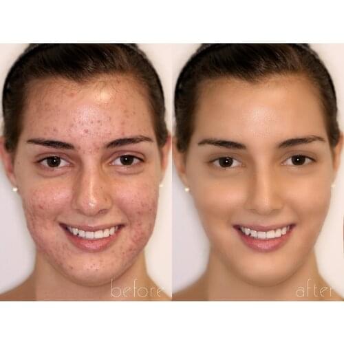 Original Retin Cream 0.05% 20g Acne Scar Removal Cream NEW RETINOL VITAMIN A CREAM 20g Anti wrinkles Blemish treatment