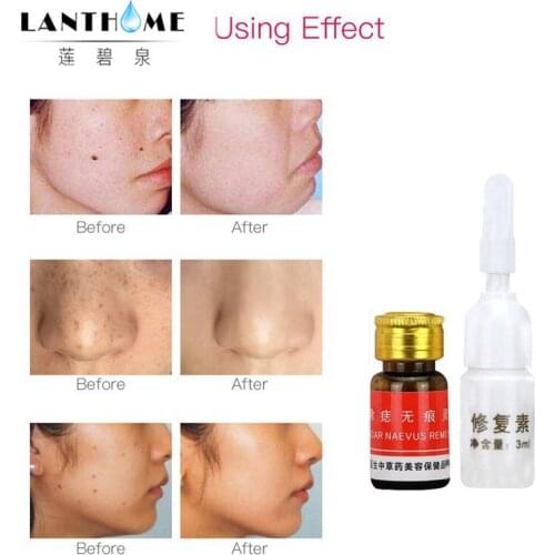 3Sets Dark Spot Tag Freckle Remove Oil Face Body Skin Tag Mole Wart Remover Eye Skin Tag Remover Painless 12 Hours Repair Liquid