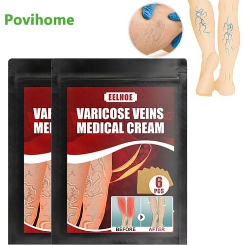 6pcs/bag Varicose Veins Plaster Vasculitis Treatment Vessel Blood Legs Inflammation Patch Angiitis Phlebitis Pain Relief Sticker