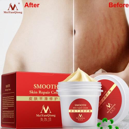 SKINEVER Cream For Stretch Marks