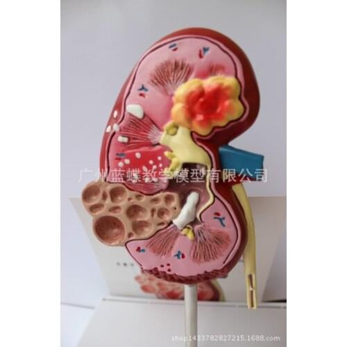 Kidney Stones Disease Model Urology Nephron Renal Glomerulus Anatomical Renal Anatomy Model Medical Teaching Supply Decor