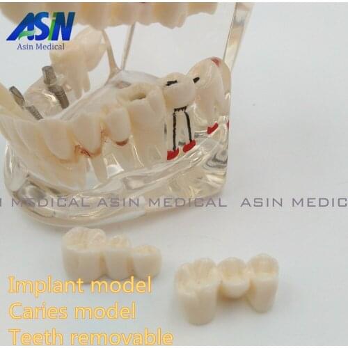 High Quality NEW arrival Dental implant Demonstration Bracket Simulation Caries Teeth Model teeth removable Dentist