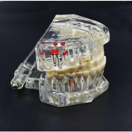 Dental Implant Teeth Model Dental Restoration Model Active Dental Lab Materila