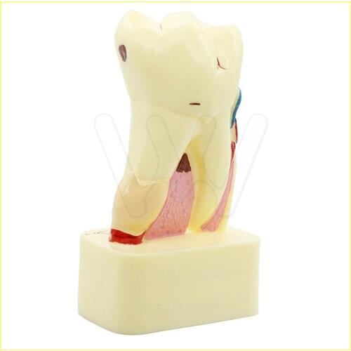 Tooth model dental pathology teeth model, dental caries, calculus, pulp stones, Occlusal tooth wear