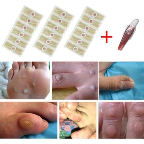 6/12PCS Medical Plaster Outdoor First Aid Foot Corn Removal Warts Repair Foot Injuries Callosity Detox Clavus Medical Patch