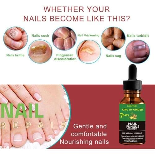 Ginger Foot Antifungal Nail Essence Nails Care Repair Nail Removal Onychomycosis Anti-Fungus Fungal Liquid Treatment I3K5