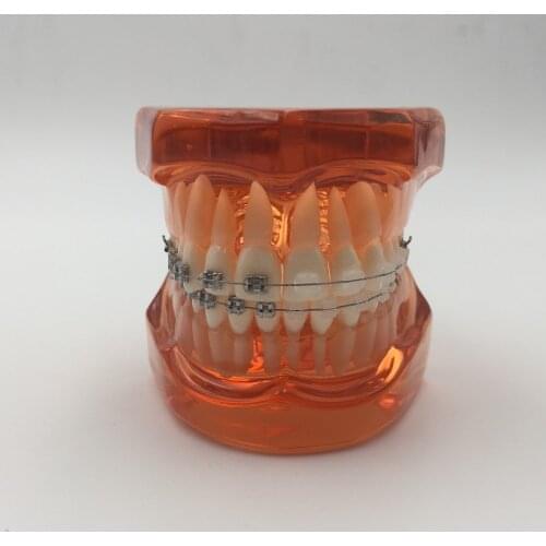 High quality 2016 new Orthodontists model With metal & ceramic brackets Ortho Metal dentist patient student learning model
