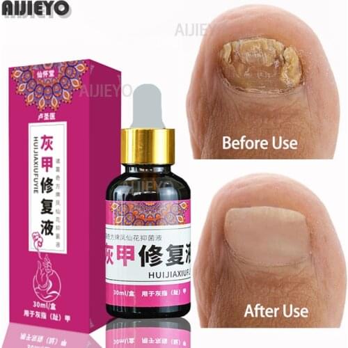 Nail Fungal Treatment Feet Care Essence Nail Foot Whitening Toe Nail Fungus Removal Gel Anti Infection Paronychia Onychomycosis