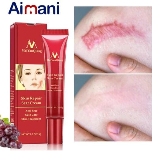15G Scar Removal Cream Acne Scars Gel Stretch Marks Surgical Scar Burn For Body Pigmentation Corrector Acne Spots Repair Care