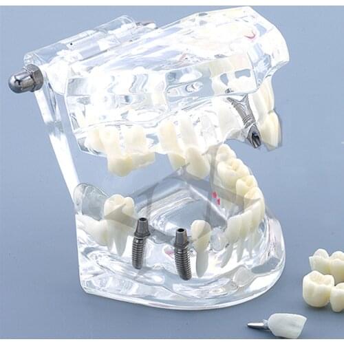 Dental Caries Teeth Model M2001 Implant Disease Teeth Model With Restoration Bridge Crown Dental Tooth Model Mariland Bridge
