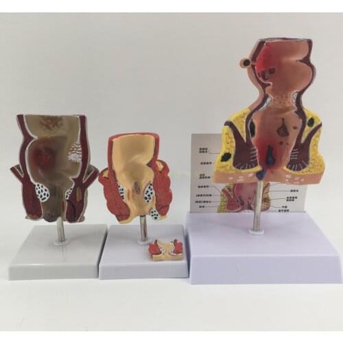 Rectal hemorrhoid disease model Internal/external hemorrhoids Anorectal model Rectal pathology model
