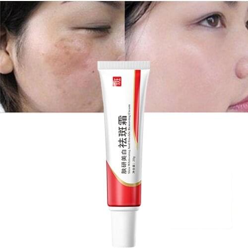 Whitening Freckle Face Cream Effective Remove Melasma Acne Spot Pigment Melanin Dark Spots Pigmentation Moisturizing Skin Care