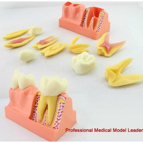 4 times tooth decomposition model tooth anatomy model of communication between doctors and patients in stomatology department