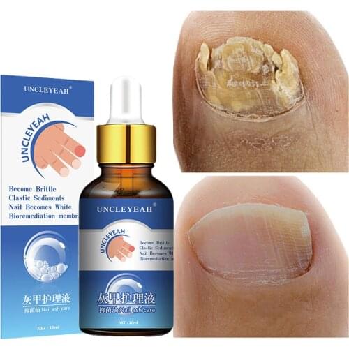 10ML Fungal Nail Treatment Serum Onychomycosis Paronychia Anti-Fungal Nail Infection Herbal Toe Fungus Foot Repair Essence Care