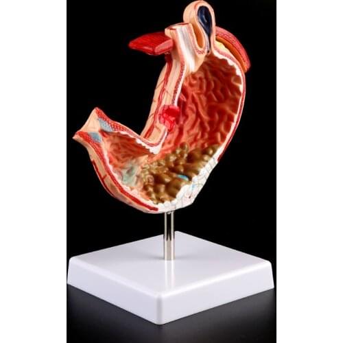 Human Anatomical Anatomy Stomach Medical Model Gastric Pathology Gastritis Ulcer Medical Teaching Learning Tool