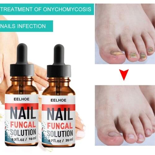 20/30ml Nail Repair Serum Essences Fungal Care Treatments Foot Nail Fungus Removal Gel Anti-infective Paronychia Onychomycosis