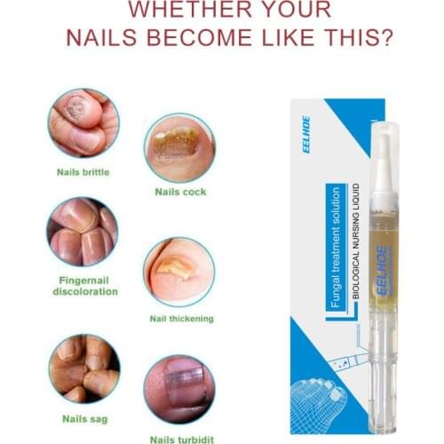 1Pcs Nail Fungus Treatments Pen Onychomycosis Paronychia Anti Fungal Nail Cuticle Remover Liquid Nail Care Serum TSLM2