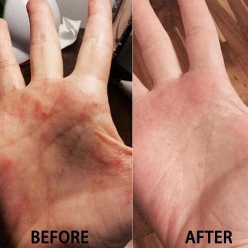 Lithospermum Ointment Fast Acting Remover Inner Thigh Paste Bleaching Marks Inflammatory Fading Stain Acne Cream Anti K1F1