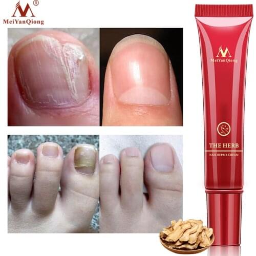 MeiYanQiong Herbal Nail Repair Cream Treatment Onychomycosis AntiFungal Paronychia Nail Infection Fungus Removal Cream Toe Care
