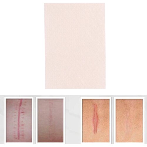 Silicone Gel Scar Sheet Removal Patch Reusable Acne Gel Scar Therapy Sheet Skin Repair 1pc Visible Scar Treatment 5cmx3.5cm
