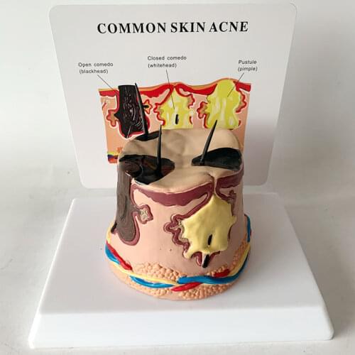 Skin structure anatomy model vinasse skin, inflamed skin, dark spots during hair growth, skin anatomical model