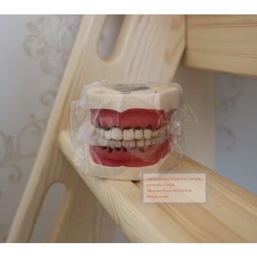 Periodontal Disease Model Dental Model Tooth Pathological Model Teeth