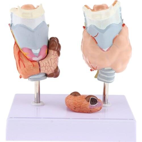 Magnified Human Thyroid Anatomical Model Normal & Diseased With Pathologies For Classroom Study Display Teaching