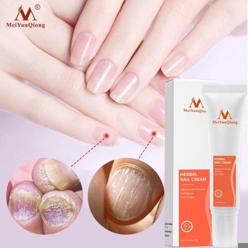 Chinese Herbal Nail Fungus Treatment Cream Anti-fungal Paronychia Gray Nail Infection Nourishing Herbal Care Nail Repair Cream