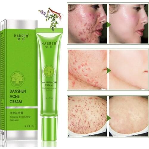Effective Acne Removal Cream Acne Treatment Fade Acne Spots Oil Control Shrink Pores Whitening Moisturizing Acne Cream Skin Care